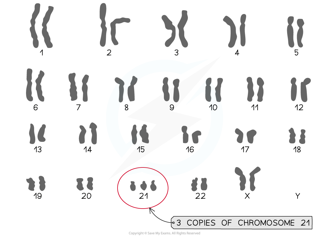 Karyogram showing Downs Syndrome Karyotype