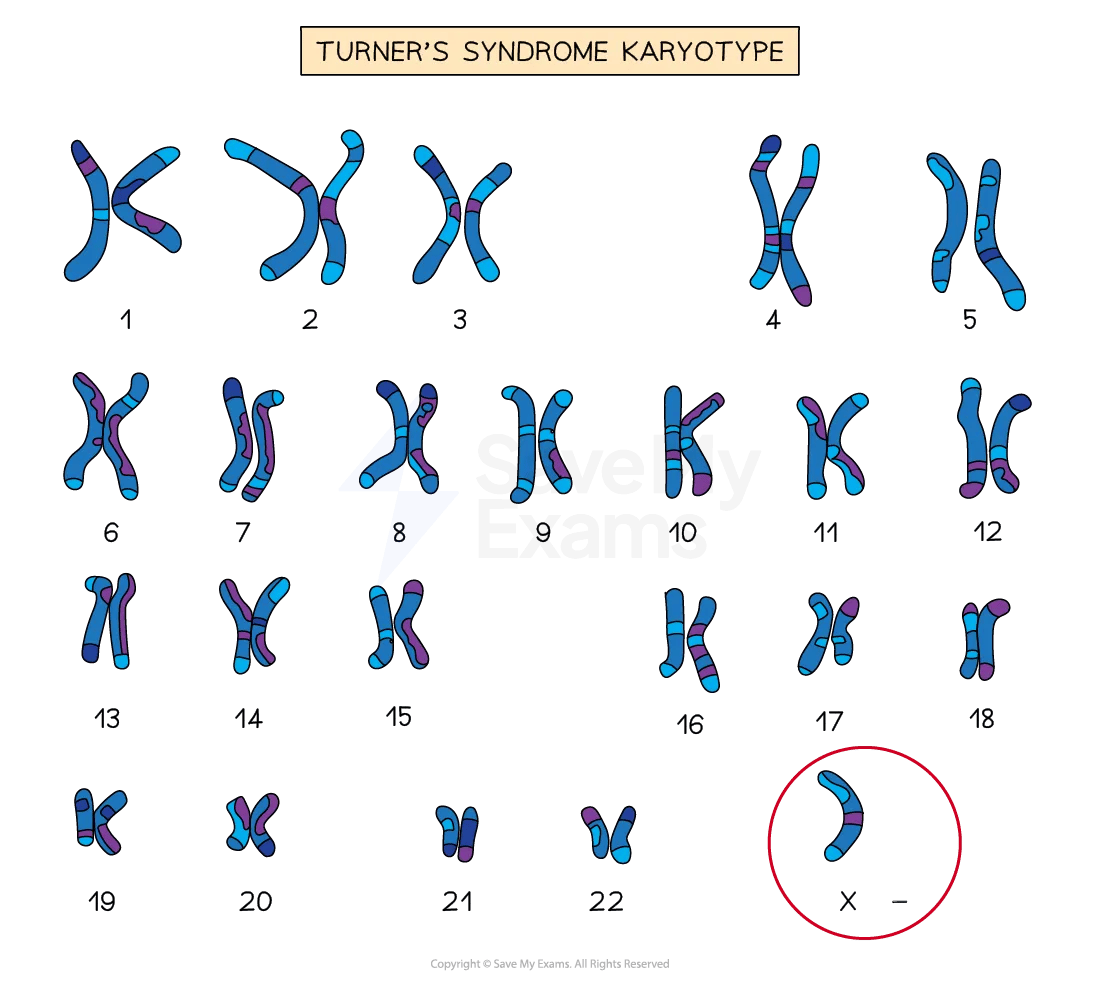 4-atypical-sex-chromosome-patterns-02-for AQA Psychology