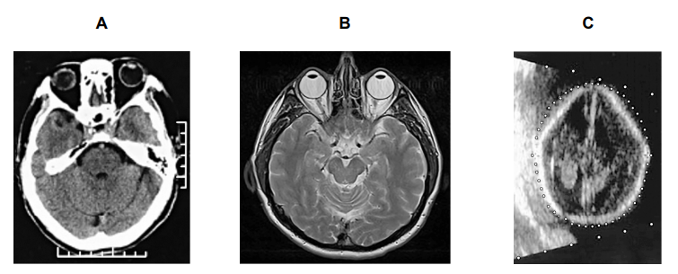 Three brain scans labelled A, B, and C. Each showing different imaging techniques.