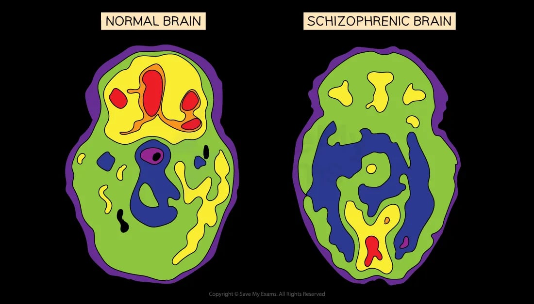 Comparison of brain scans: left shows a normal brain with varied colours; right shows a schizophrenic brain with less distinct colour variation.
