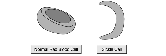 Illustration comparing a normal round red blood cell to a crescent-shaped sickle cell, highlighting shape differences.