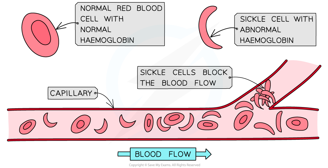 Diagram showing normal red blood cells and sickle cells in a capillary. Sickle cells block blood flow due to abnormal haemoglobin.