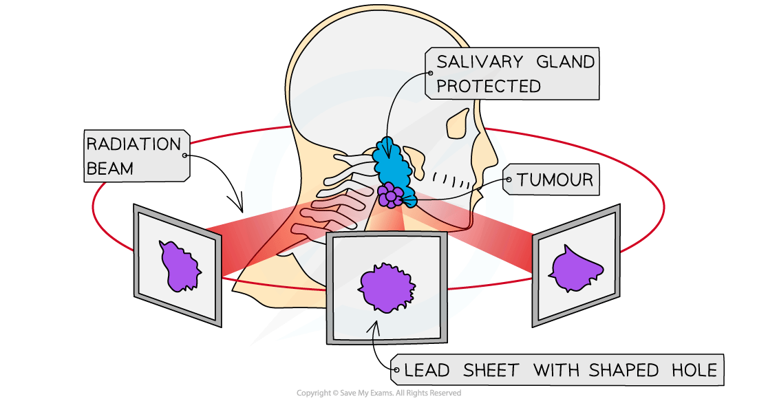 Diagram of a head showing targeted radiation therapy. Radiation beam passes through lead sheet with a hole, aimed at a tumour, sparing salivary gland.