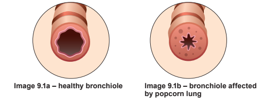 Side-by-side diagrams show a healthy bronchiole and a bronchiole affected by popcorn lung, illustrating structural changes and narrowing.