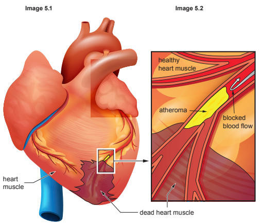 Diagram showing a heart with a detailed section of an artery; labels indicate healthy muscle, atheroma causing blocked blood flow, and dead heart muscle.