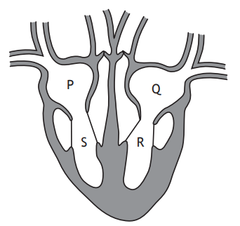 Diagram of a heart showing labelled sections: P and Q for upper chambers, S and R for lower chambers, with connecting vessels above and valves depicted.