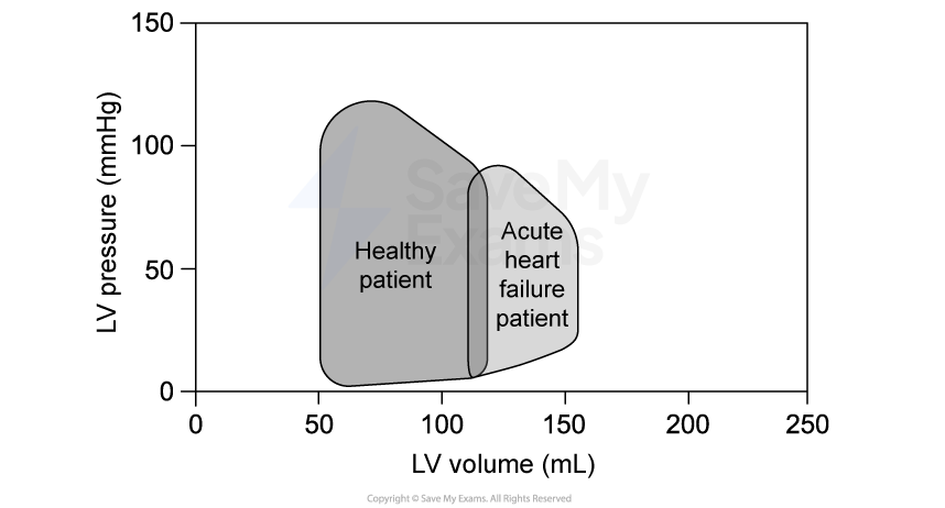 Graph comparing left ventricular (LV) pressure-volume loops for a healthy patient and an acute heart failure patient, highlighting differences in loop shapes.
