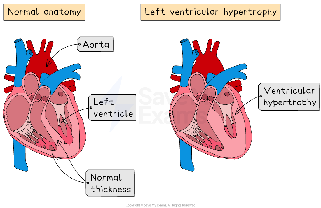 Comparison of normal heart anatomy with left ventricular hypertrophy, showing thickened heart muscle, labelled parts in contrasting colours.