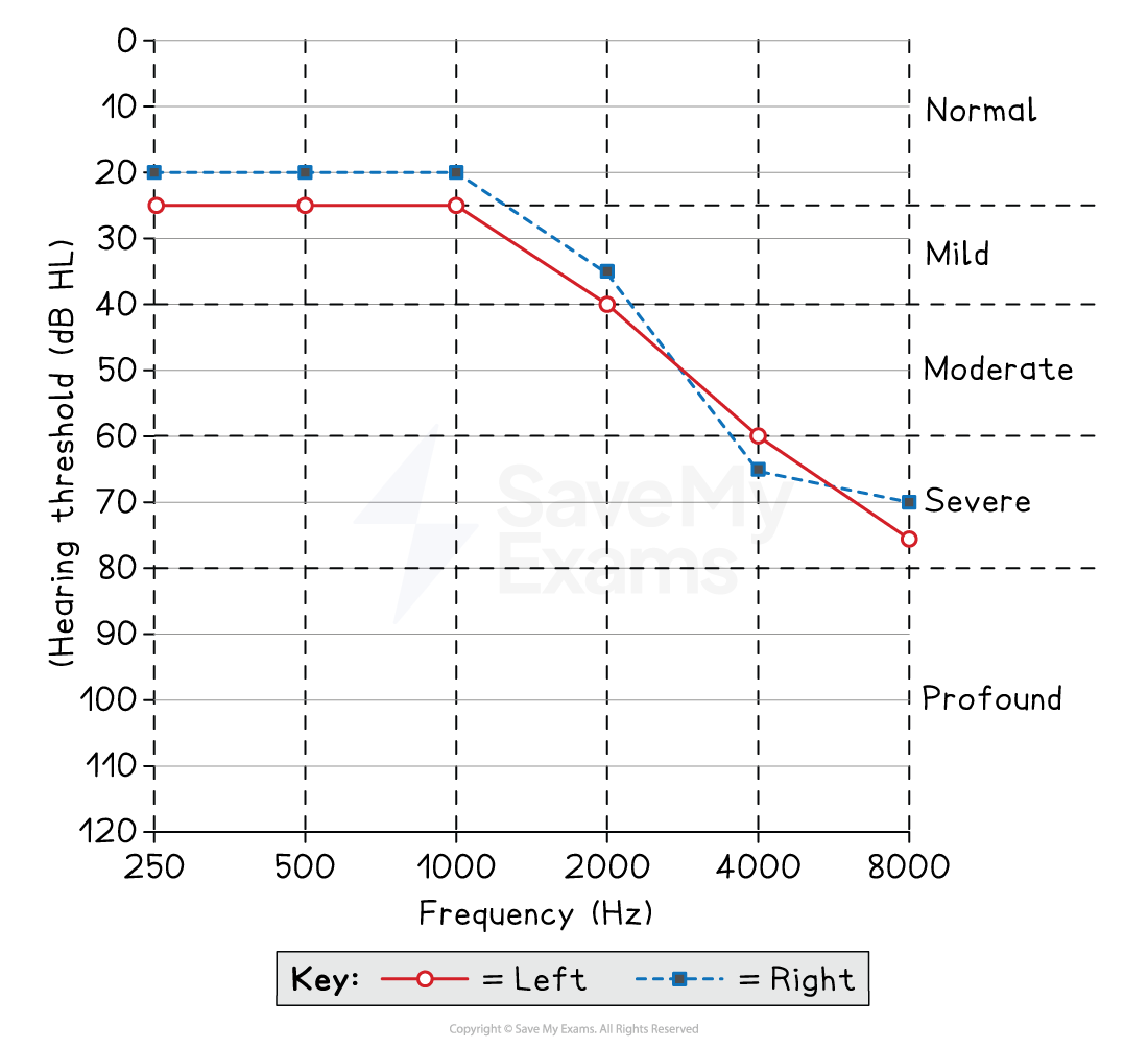 Audiogram showing hearing thresholds for left ear in red and right ear in blue. Levels range from normal to severe across frequencies 250-8000 Hz.
