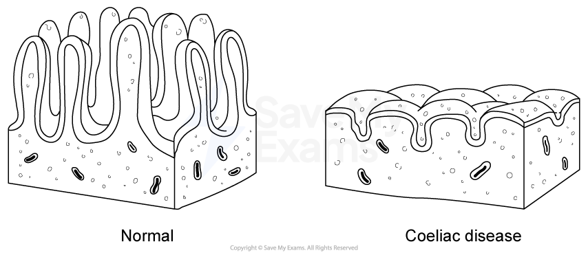 Comparison of intestinal villi: normal villi on the left, tall and dense; coeliac disease on the right, shorter and less dense.