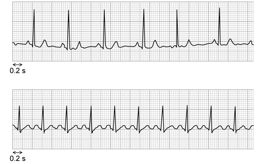 Two ECG strips showing heart rhythms are displayed on a grid. Both strips include repeated peaks and waves representing cardiac activity.