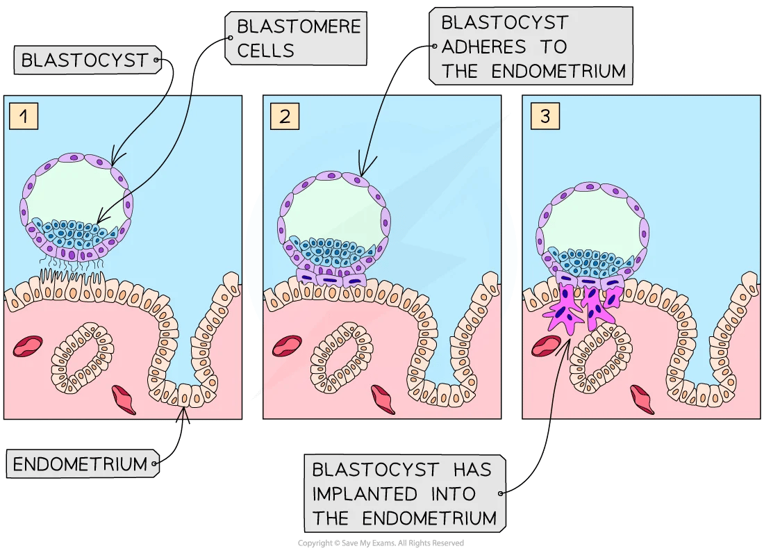 Diagram of a blastocyst adhering to and implanting into the endometrium in three stages, showing blastomere cells and endometrial lining.