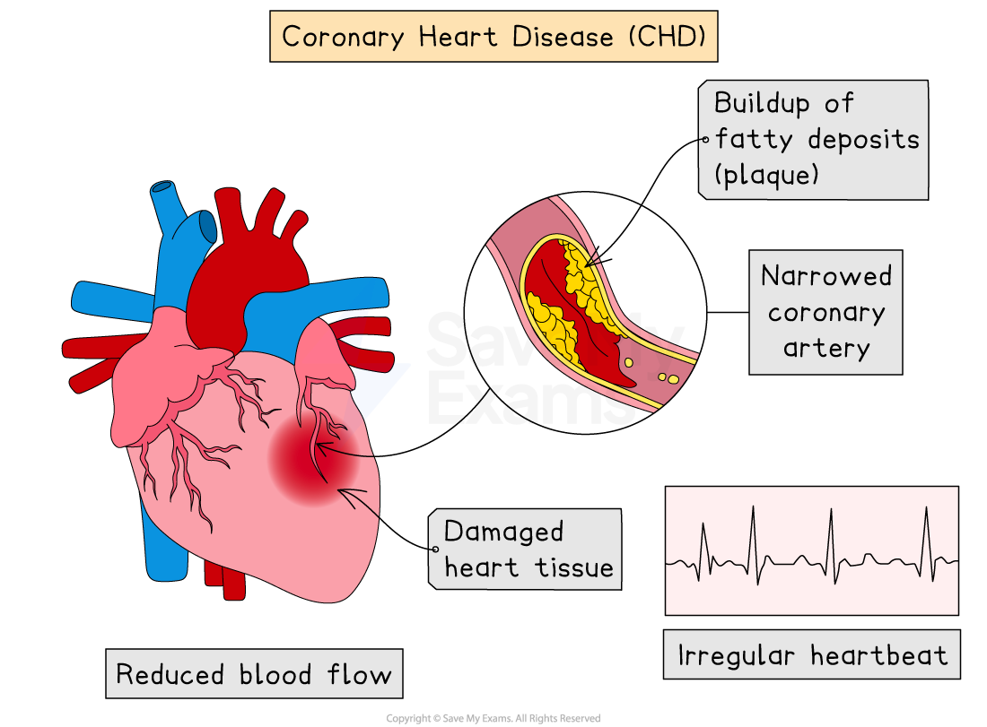 Diagram of coronary heart disease, showing narrowed arteries with plaque, reduced blood flow, damaged heart tissue, and an irregular heartbeat graph.