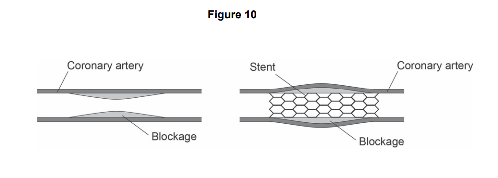 Diagram of a coronary artery with a narrowed blockage, and after insertion of a mesh stent holding the artery open around the blockage.