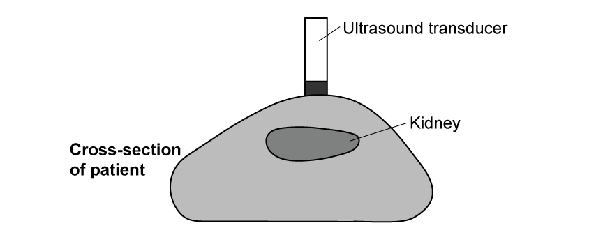 A cross-section of a patient, showing an ultrasound transducer on the skin above a kidney inside the body.