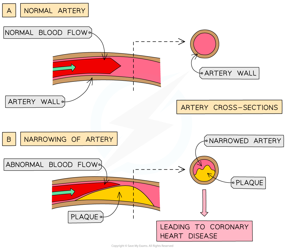 Diagram comparing normal and plaque‑narrowed coronary arteries, showing the reduction in blood flow and smaller cross‑sectional lumen area in a narrowed artery, leading to coronary heart disease.