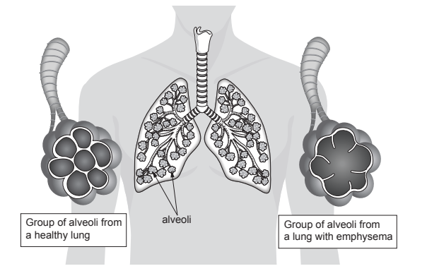 [Figure: Image 7.2 — two diagrams of groups of alveoli, one from a healthy lung showing many small, intact alveoli, and one from a lung with emphysema showing fewer, larger, damaged alveoli with broken walls]