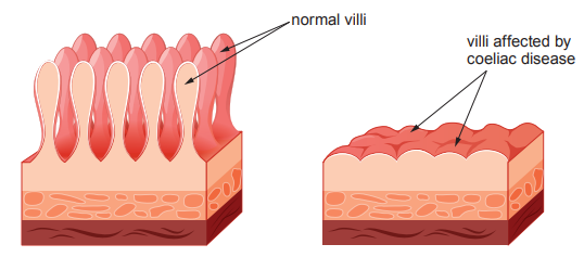 [Figure: diagram comparing normal villi lining the small intestine with villi affected by coeliac disease, showing the flattened, reduced structure in the affected tissue]