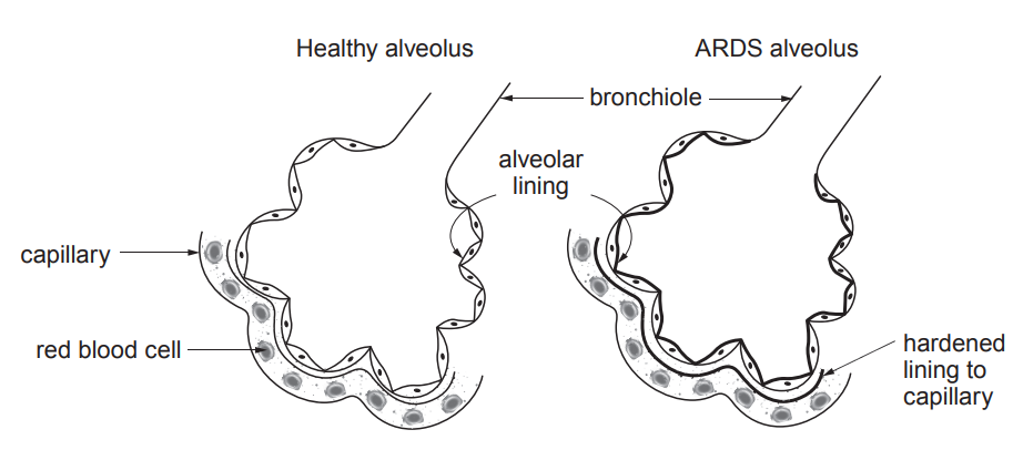 [Figure: Two diagrams side by side. The healthy alveolus shows a capillary containing a red blood cell, alveolar lining, and bronchiole, with a thin lining. The ARDS alveolus shows the same structures but with a hardened lining to the capillary]

