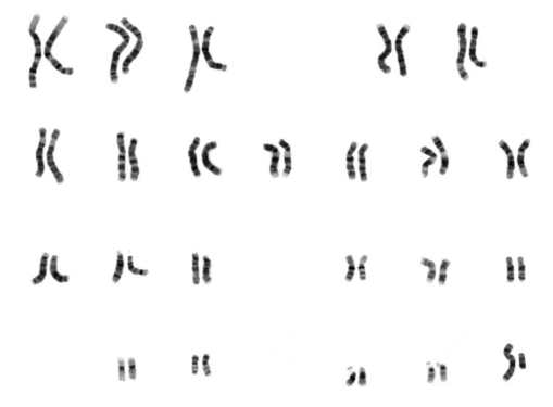 ![Figure: karyotype image showing a complete set of paired chromosomes from a cell, arranged in order by size, with the sex chromosome pair positioned at bottom right]