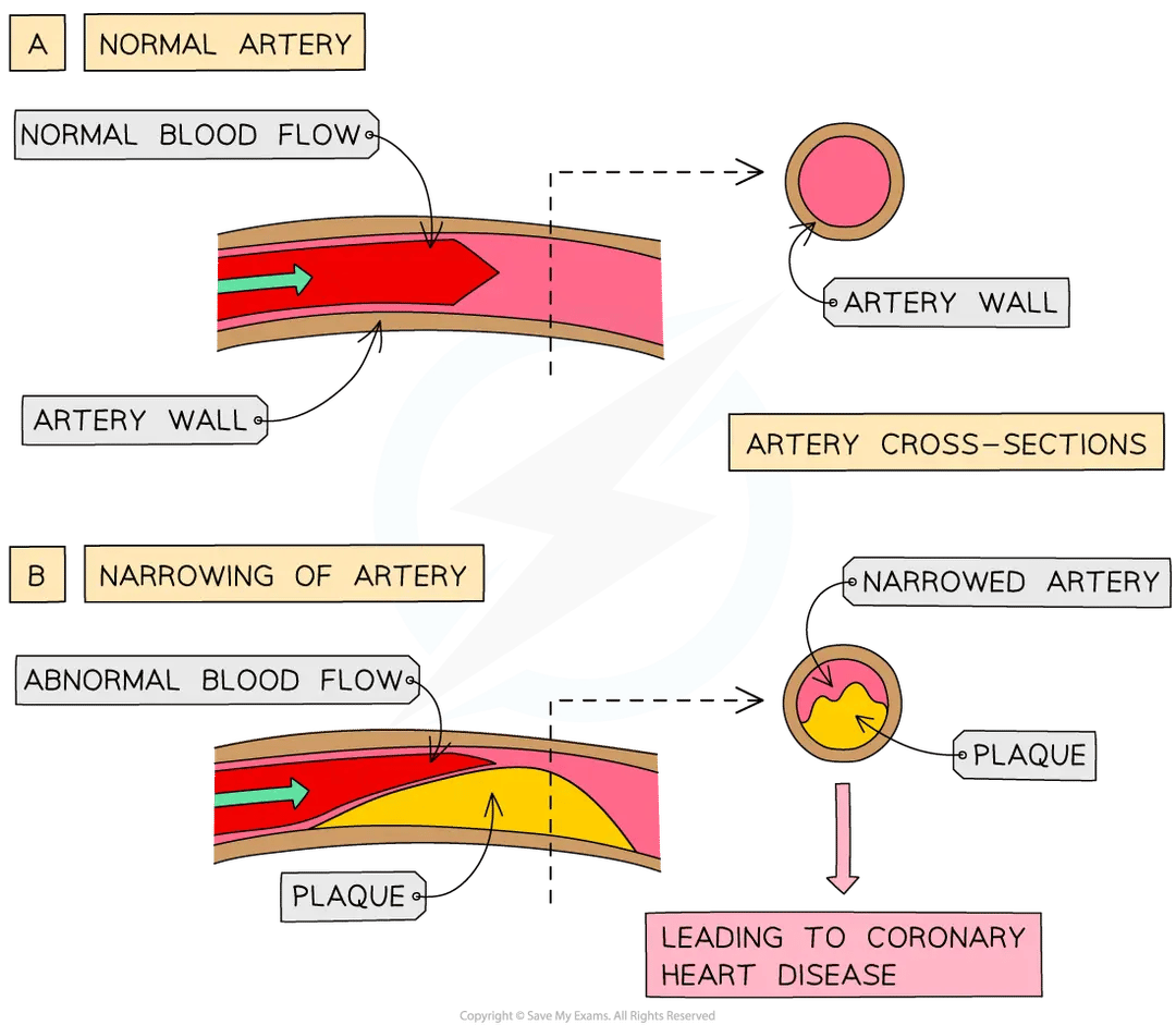 Diagram comparing a normal artery, with normal blood flow and open lumen, with a narrowed artery containing plaque, causing abnormal blood flow; cross-sections show the narrowing leading to coronary heart disease.