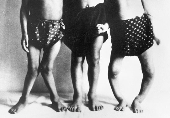 rickets in 3 children